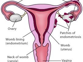 endometriosi