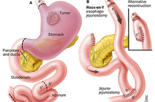 Gastrectomia